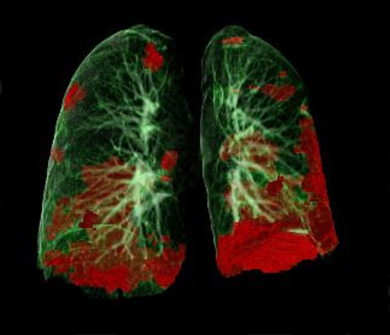 Das CT-Bild zeigt die durch SARS-CoV-2 geschädigten Lungenareale (in Rot). Typisch für COVID-19 ist die Schädigung der Lunge beidseits und basal (in den unteren Bereichen). 