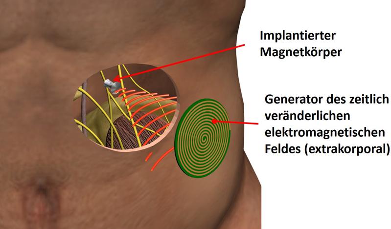 Prinzipskizze des »Magnetoceuticals«-Ansatzes: Lediglich ein magnetischer Implantatkörper wird in den menschlichen Körper implantiert. Die gesamte Intelligenz des elektronischen Systems sitzt in einer extrakorporalen, miniaturisierten Elektronik.