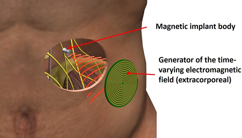 Principle sketch of the "Magnetoceuticals" approach: Only a magnetic implant body is implanted into the human body. The entire intelligence of the electronic system is located in the extracorporeal, miniaturized electronics.
