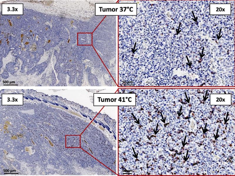 Signifikant vermehrte Wanderung NIS-tragender MSCs (rot gefärbte Zellen) in Tumoren, die mit Hitze behandelt wurden (41°C) im Vergleich zu den Kontrolltumoren (37°C)