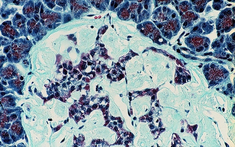 Eiweißablagerungen in der Bauchspeicheldrüse bei einem Javaneraffen mit Diabetes mellitus.