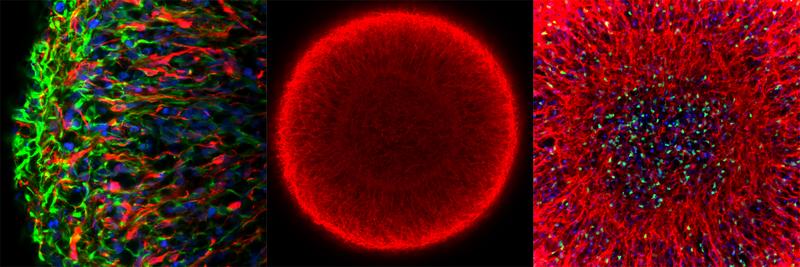 Midbrain organoids from smNPCs in the microscope: Left: outer region of an organoid, middle: whole organoid, right: center of the organoid.