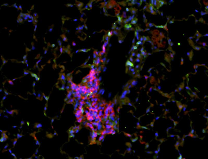 Lungenabschnitt von Mäusen, die sechs Monate lang chronischem Zigarettenrauch ausgesetzt waren. Hier sind die sich entwickelnden Follikel, ein charakteristisches Merkmal der COPD, sichtbar (B-Zellen in Violett, T-Zellen in Grün und Zellkerne in Blau).