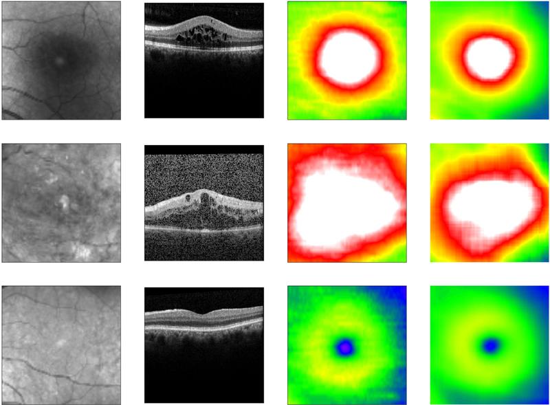 Algorithmus sagt die Netzhautdicke voraus. Von links nach rechts: Fundus-Bild, OCT-Bild, tatsächliche Netzhautdicke, vorhergesagte Netzhautdicke. 