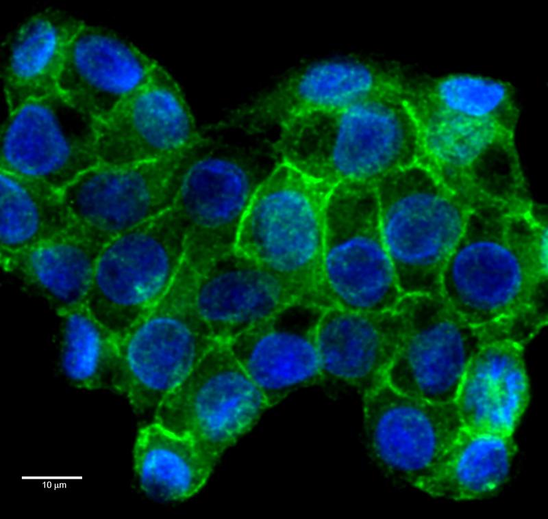 Darmkrebszellen mit PD-L1 Protein (grün) auf der Oberfläche, sichtbar gemacht mittels Immunfärbung, sowie DNA (blau). PD-L1 bremst wichtige Immunzellen aus und wird von vielen Krebszellen vermehrt gebildet. 