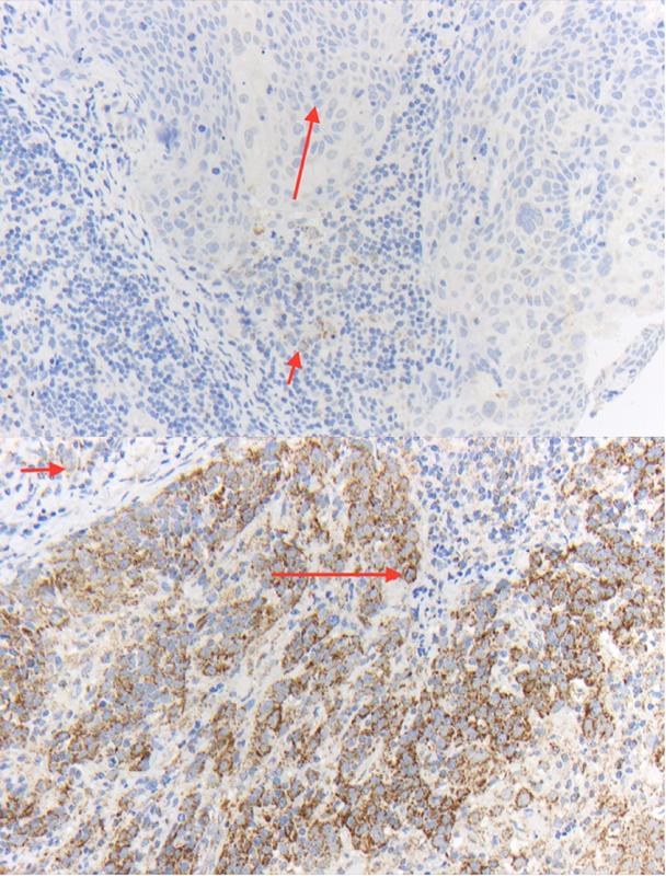 Immunhistochemische Färbung von ATP5B für HPV-negative (oben) und HPV16-positive (unten) Oropharynxkarzinome (Vergrößerung: 200x)