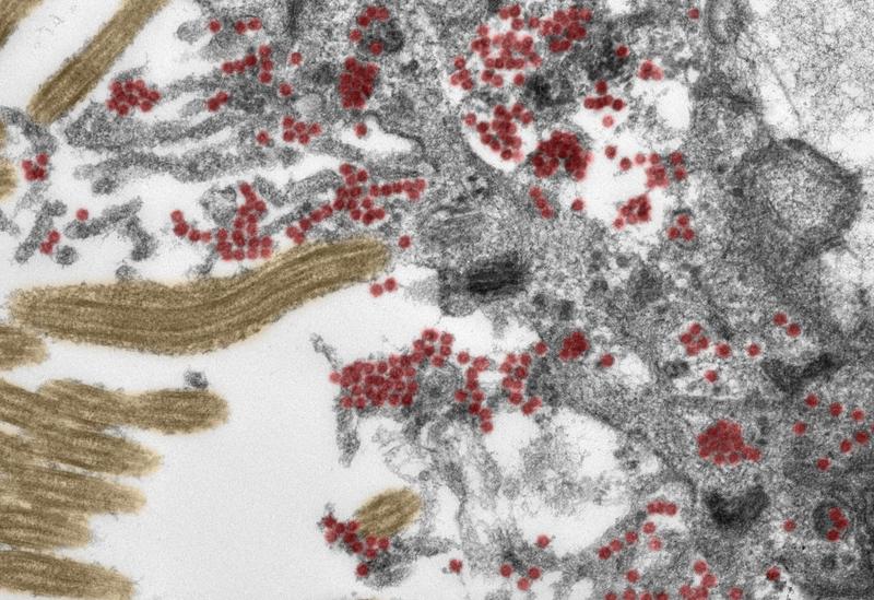 EM-Aufnahme (koloriert): Ausschnitt einer Zelle in der Riechschleimhaut. Sowohl innerhalb der Zelle als auch auf den Zellfortsätzen findet sich eine große Zahl intakter SARS-CoV-2-Partikel (rot). Gelb: Flimmerhärchen.