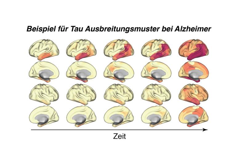 Beispiel für Tau-Ausbreitungsmuster bei Alzheimer
