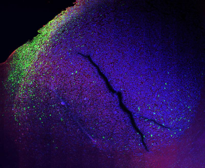 Bisher nur vermutet, jetzt dank des molekularen Reporters sichtbar gemacht: Wo menschliche Tumorzellen und Gehirnzellen einer Maus aufeinandertreffen, haben die Tumorzellen eine andere Identität als überall sonst (grün).
