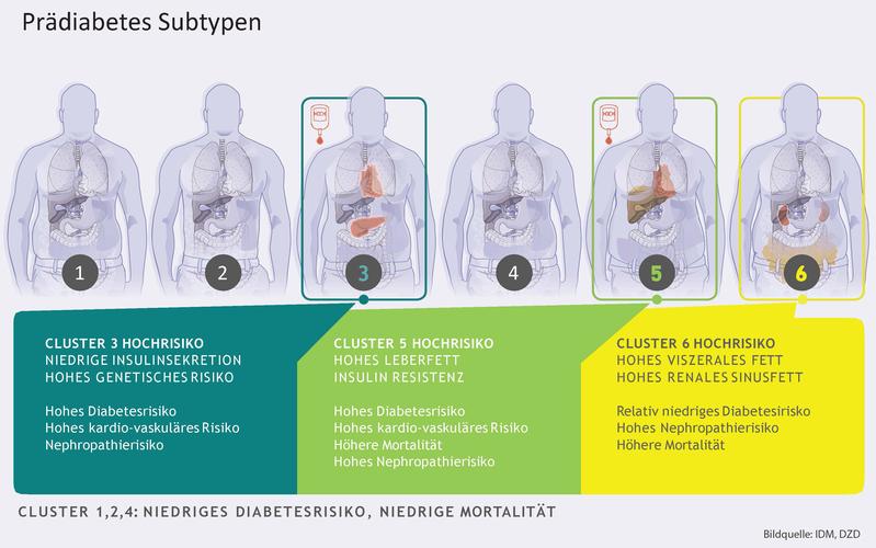 Bei Menschen mit Prädiabetes gibt es sechs klar abgrenzbare Subtypen (Cluster), die sich in der Krankheitsentstehung, dem Risiko für Diabetes und der Entwicklung von Folgeerkrankungen unterscheiden.