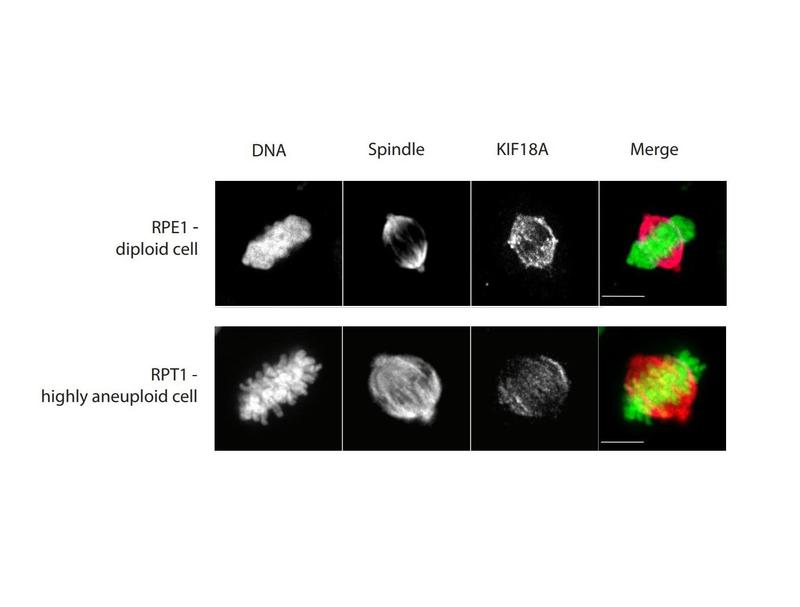 Teilung einer normalen Zelle (oben) und einer Zelle mit abnormal hoher Anzahl an Chromosomen (unten). (v.l.n.r.): DNA, mitotische Spindelstruktur, Anwesenheit des KIF18A-Proteins sowie alles in einem (DNA grün, Spindel rot). Maßstab (weiß): 10 Mikrometer.