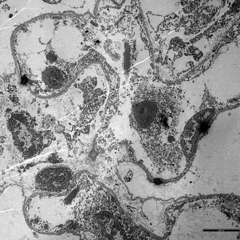Krankhaft vermehrtes Bindegewebe zwischen Lungenepithel- und Kapillarendothelzellen