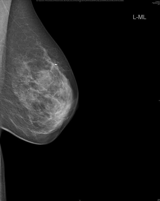 In dieser Mammographie-Aufnahme scheint der Tumor noch vorhanden, bei der Gewebeanalyse nach der OP wurden allerdings keine lebenden Krebszellen mehr nachgewiesen.