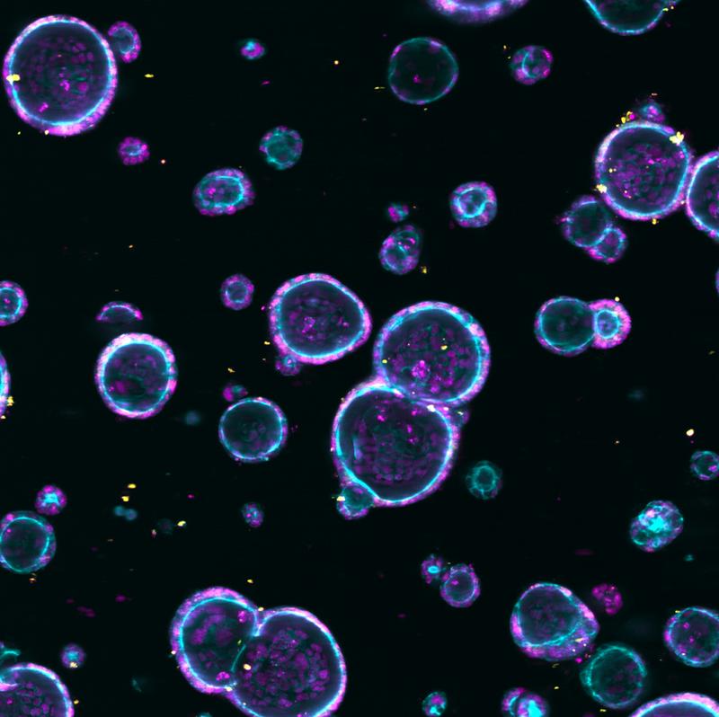 Mit Fluoreszenzmarkern angefärbte Organoide aus dem Gewebe von Darmkrebspatienten. 