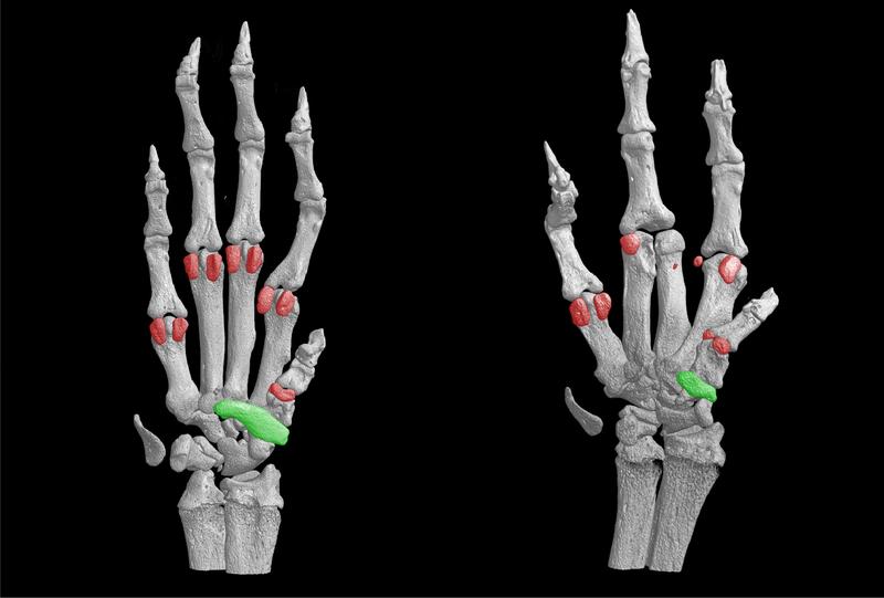 Bone staining of the hand-paw isolated from a normal mouse (left) and a diseased mouse (right). The animal model displays malformations of the limbs such as the reduced size (in green) or the absence (in red) of ventral bones. 