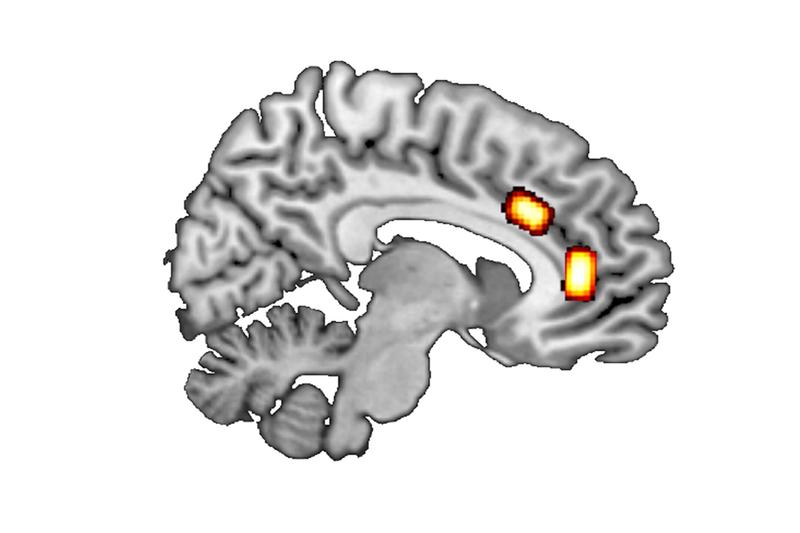 Längsschnitt durch das Gehirn: An den markierten Stellen (oben: dorsaler anteriorer zingulärer Kortex; weiter vorn/unten: ventromedialer Präfrontalkortex) wurden die GABA/Glutamat-Konzentrationen gemessen.
