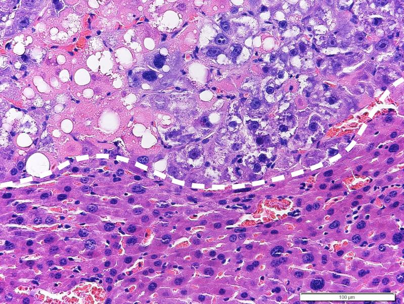 Lebertumor unterm Mikroskop. Tumorzellen (oberer Bereich) durch die lipotoxische Therapie stark angegriffen, (es entstehen charakteristische Lipidtröpfchen und Zelltod), sind die normalen Leberzellen (unterer Bereich) durch die Therapie kaum betroffen