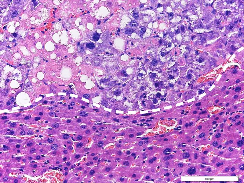 Treated liver tumor under the microscope. While the tumor cells (upper part) are strongly affected by the lipotoxic therapy (formation of characteristic lipid droplets and cell death), normal liver cells (lower part) are only barely affected by the therapy