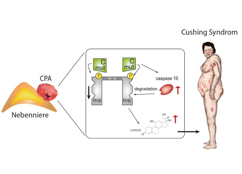 Bei einer Nebenniere mit eine gutartige Nebennierenadenom (links) ist der dem Protein-Kinase-A-Signalweg verändert (Mitte). Die Betroffenen entwickeln in der Folge die typischen Cushing-Syndrom-Merkmale