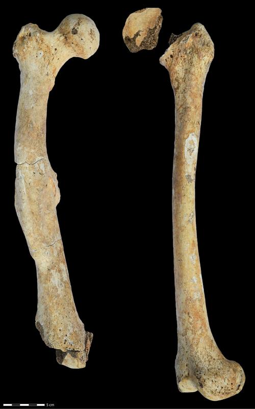 Rechter und linker Oberschenkelknochen (Os femoris) mit krankhaften Veränderungen des für die Studie untersuchten Mannes aus dem Nordkaukasus.