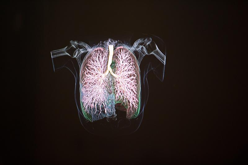3D visualization of lung areas. 