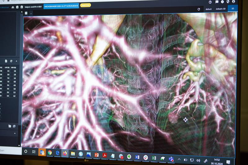 Bronchial tubes are attacked by the virus in particular: Excerpt from a 3D visualization of lung areas. 