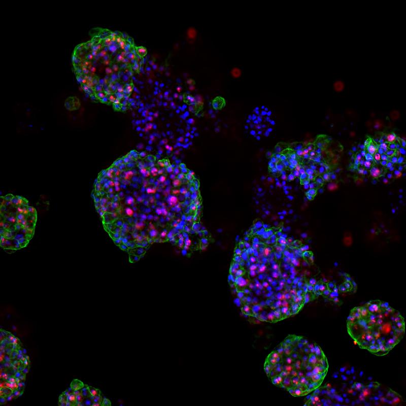 Wuchernde Prostatakrebs-Organoide: Tumor-Rezeptoren (grün), sich teilende Zellen (rot) und DNA in den Zellkernen (blau).