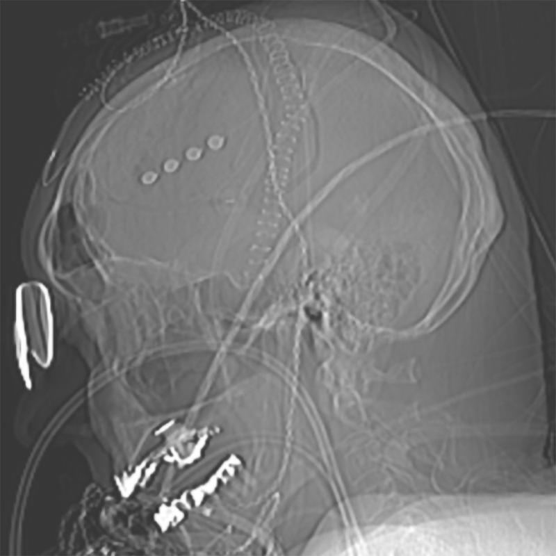 Seitliche Schädelaufnahme eines Patienten mit subduralem Hämatom und auf dem Hirn aufgelegter 4-Kontakt-EEG-Elektrode (vier Punkte), mit der Anfälle detektiert werden können (1).