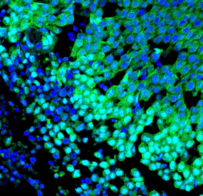 Immunfluoreszenzbild eines basalen Brusttumors mit starker Kernlokalisation des onkogenen Proteins YAP (grün) und Kernen (blau). 