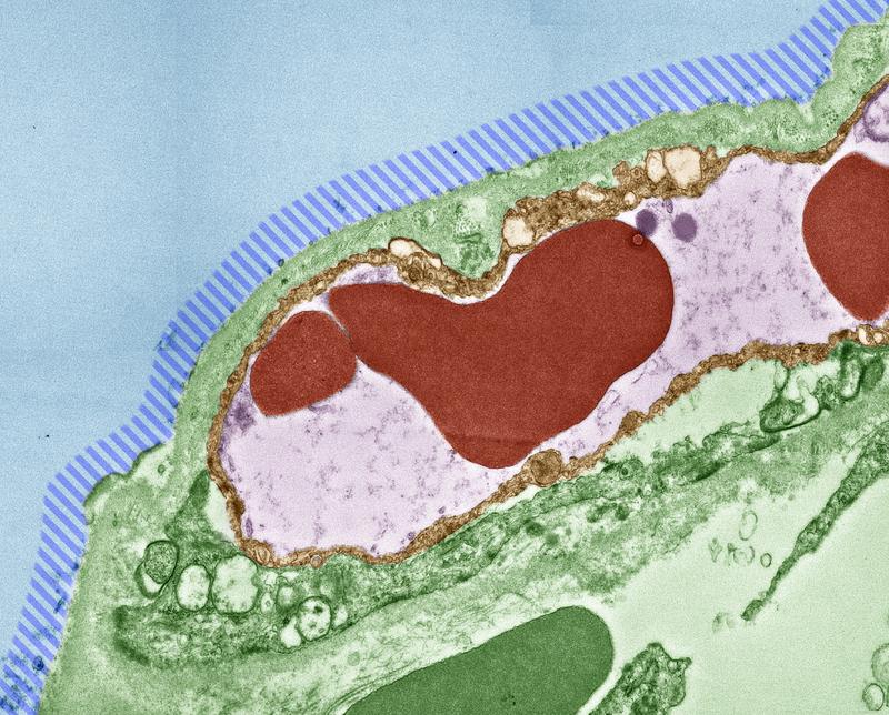 COVID-19-Gewebeschaden in der Lunge: Im gestreiften Bereich fehlt die äußere Zellschicht, die für Funktion und Stabilität des Lungenbläschens notwendige oberflächenaktive Substanzen produziert. Rot: Blutkörperchen, blau: Atemluft. TEM, nachkoloriert
