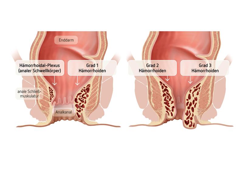 Hämorrhoiden sind blutgefüllte, spezielle arteriovenöse "Kissen", die sich im Analkanal befinden und hauptsächlich dem Feinverschluss des Afters dienen. Vergrößerte Hämorrhoiden können symptomatisch werden und werden als Hämorrhoidalleiden bezeichnet.