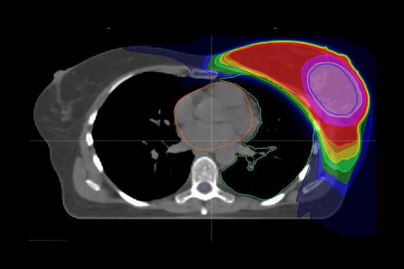 Kürzere Bestrahlungszeit bei Brustkrebs durch integrierte Boost-Bestrahlung: Der Bereich der höchsten verabreichten Strahlendosis ist rosa markiert.