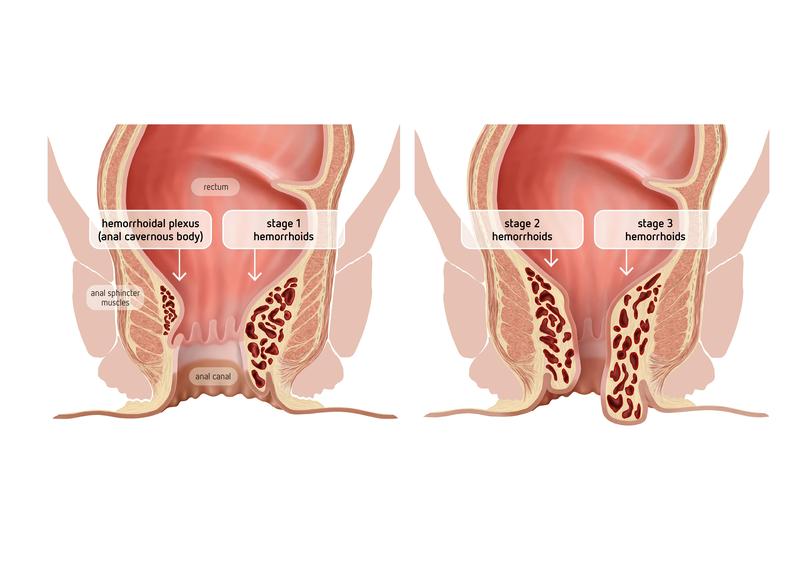 Hemorrhoids are blood-filled specialized arteriovenous “cushions” located in the anal canal and mainly serve as a fine closure thereby contributing to fecal continence. Enlarged hemorrhoids can become symptomatic and are referred to as hemorrhoidaldisease