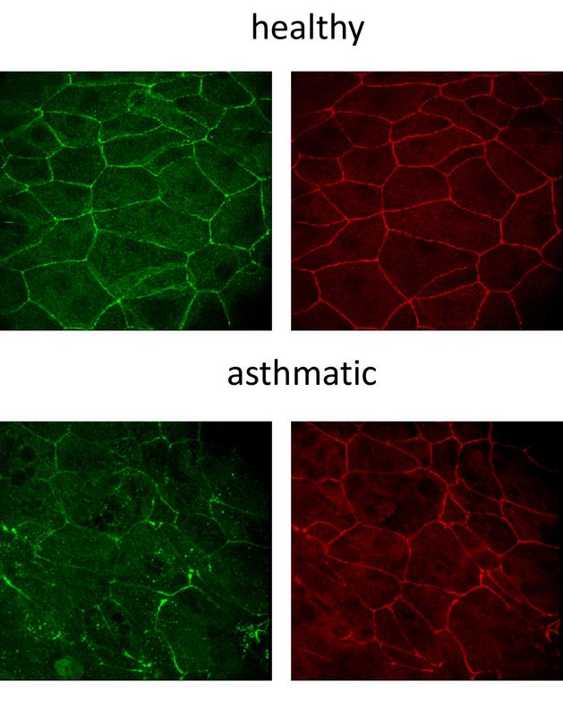 Straight and clear epithelial barrier of healthy bronchial epithelial cells (at the top) and leaky and damaged asthmatic epithelial cells (at the bottom). 