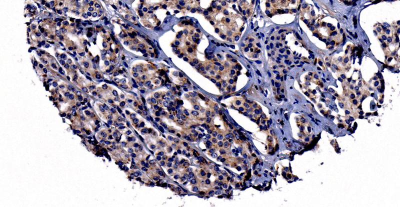 Prostatakarzinomzellen - mit Nachweis des Neuropilin-2-Proteins in braun. Der Nachweis erfolgte über Immunhistochemie an Formalin fixierten und in Paraffin eingebetteten Gewebe. 