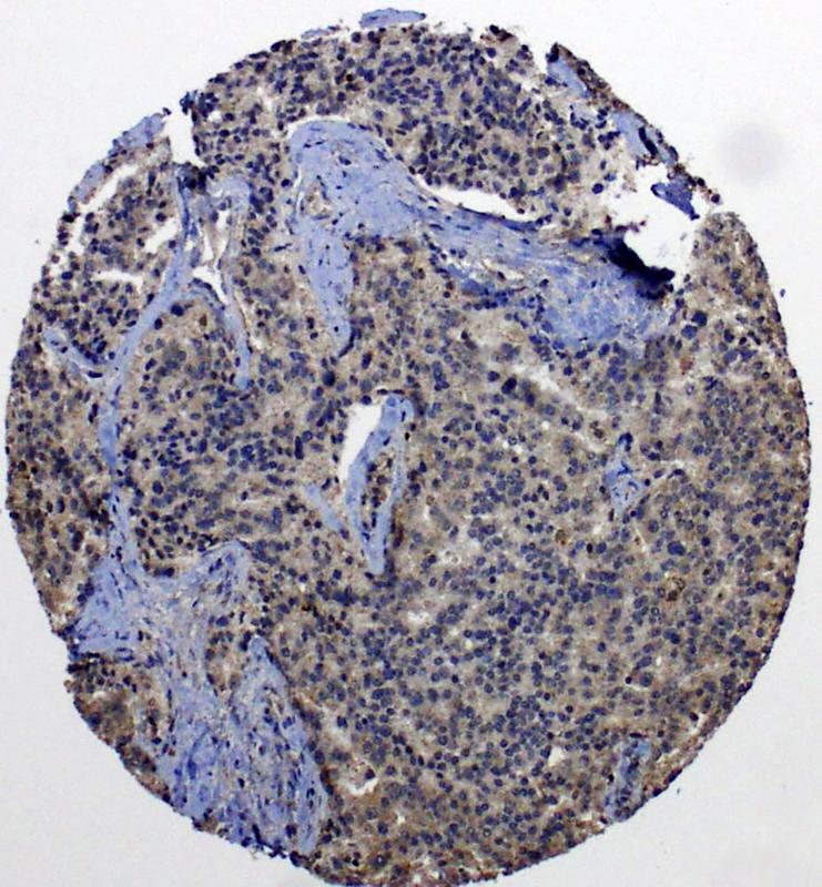 Metastasierte Prostatakarzinomzellen mit starker Expression des Neuropilin-2-Proteins (bräunliche Farbe). Das Gewebe wurde zunächst mit EDTA schonend entkalkt, um dann mit Hilfe von Neuropilin-2 spezifisch detektierenden Antikörpern gefärbt zu werden.