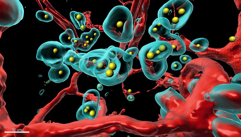 Ein Stück des Tumors wurde durchsichtig gemacht und in 3D durchsucht. Die mit fluoreszierenden Farben markierten Bestandteile wurden am Computer in eine 3D-Darstellung übertragen (rot: Blutgefässe, türkis: Tumorzellen, gelb: therapeutischer Antikörper).