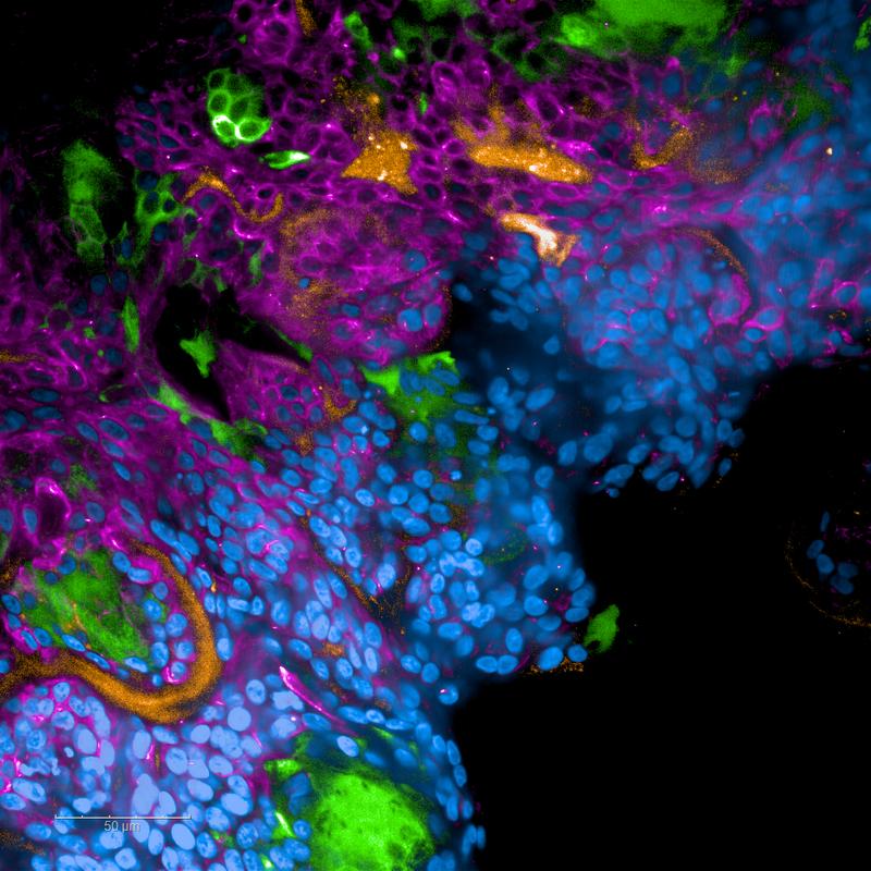 Fluoreszenzmikroskopische Aufnahme eines mit SARS-CoV-2-infizierten Lungengewebes.