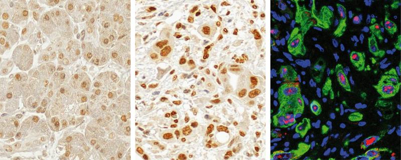 Die Mehrzahl der Bauchspeicheldrüsentumore weist einen höheren Gehalt des Enzyms PRMT1 auf (mittleres Bild) als krebsfreies Gewebe des Organs (Bild links), wie die Intensität der Braunfärbung zeigt. Rechts: Krebshemmer p14ARF (rot gefärbt) im Tumorgewebe