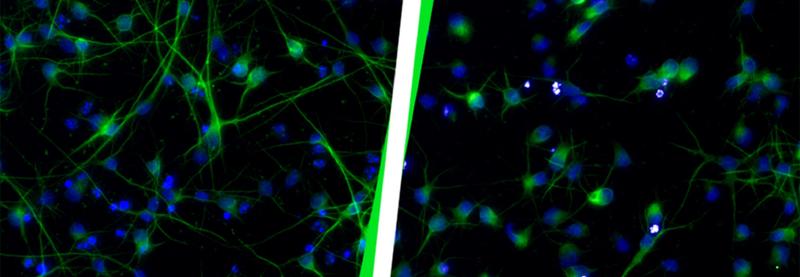 Gesunde Neuronen (links) im Vergleich zu Neuronen nach einer Aktivierung von HERV-K(HML-2) (rechts). Die Neuronen auf der rechten Seite haben ihre Funktion verloren und zeigen einen anderen Phänotyp. 