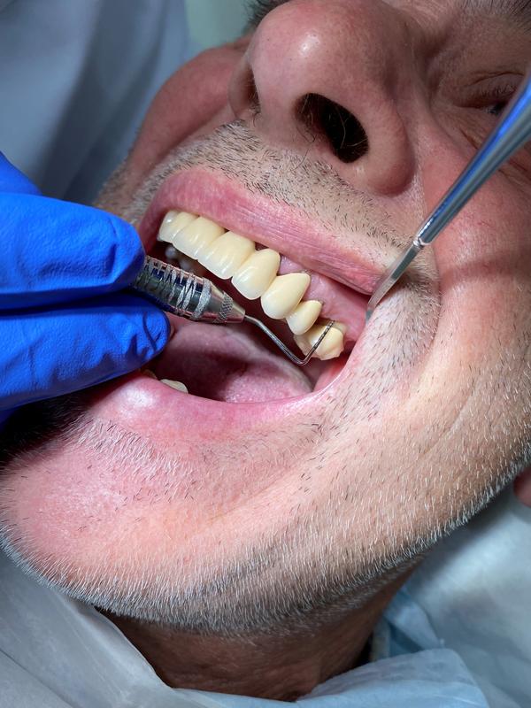 Die Kontrolle der Zahnfleischtaschen (bis 3 mm gesund) mit einer speziellen parodontalen Sonde. 