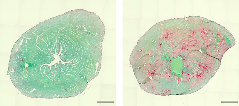 Herz einer gesunden (links) und einer kranken Maus (Schnittbilder). Durch Bindegewebseinschlüsse (rechts, rot) ist das kranke Herz weniger leistungsfähig.