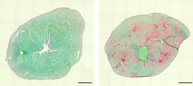 Heart of a healthy (left) and a diseased mouse (cross sections). Connective tissue inclusions (right, red) make the diseased heart less efficient.