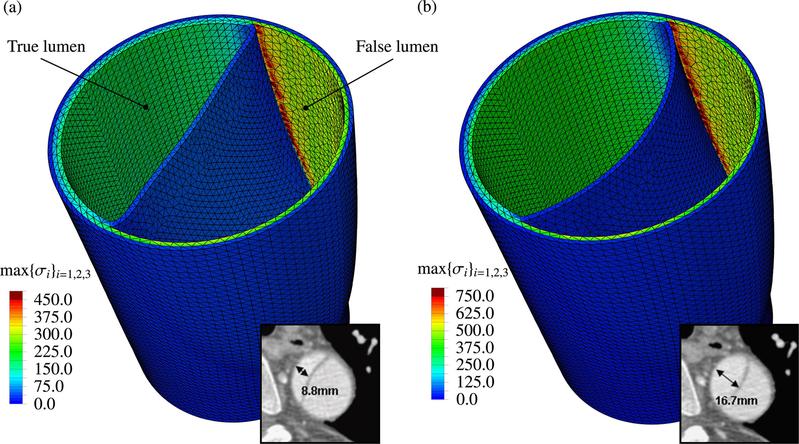Vorherrschender Spannungszustand im falschen und richtigen Lumen bei (a) diastolischem und bei (b) systolischem Blutdruck im Vergleich mit CT Aufnahmen.