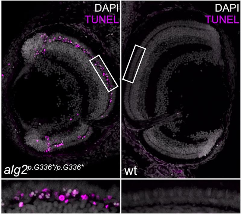 Die Netzhaut der Medakafische mit Mutation im ALG2-Gen zeigt einen voranschreitenden Verlust (magentafarben) der Stäbchenzellen (links) im Gegensatz zu wildtypischen Individuen. Dieses Symptom ist auch als Nachtblindheit oder Retinitis pigmentosa bekannt.