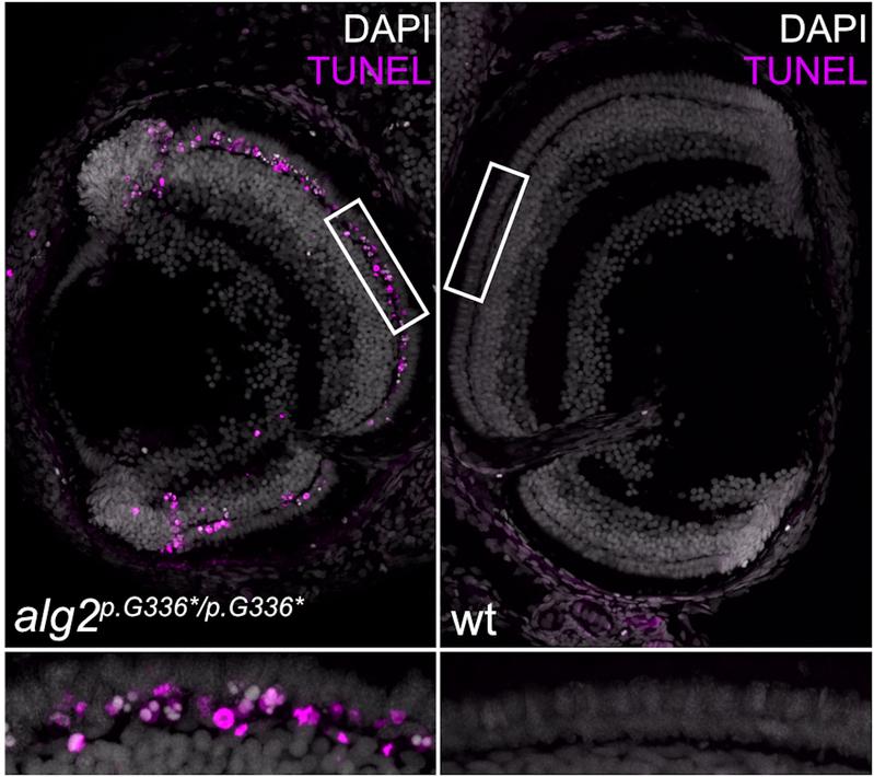 The retina of the medaka fish with a mutation in the ALG2 gene shows progressive loss (magenta colours) of the rod cells (left) in contrast to wild-type specimens. This symptom is also known as night blindness or retinitis pigmentosa.