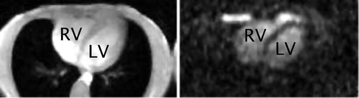 Diese Bilder vom Herzen eines gesunden Menschen wurden mit Hilfe der Magnetresonanztomographie (MRT) gewonnen. Links ein mit der herkömmlichen Protonen-MRT erzeugtes Bild, rechts das zugehörige Natrium-MRT-Bild. Aufnahmen: Renate Jerecic