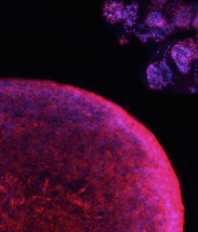 Die Mikroskop-Aufnahme zeigt „Mini-Hirntumoren“, sogenannte Tumor-Organoide, die im Labor aus Zellen von Patienten für die Krebsforschung gezüchtet wurden.