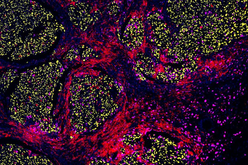 Immune cells (red and magenta) infiltrating a skin tumour in a patient melanoma (yellow) biopsy