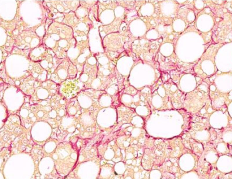 Lebergewebe mit Fibrose und rot markierten Kollagenfasern